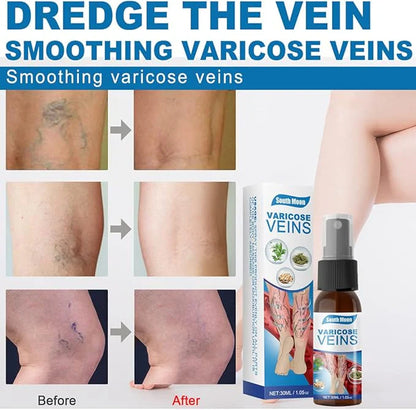 South Moon - Varicose Veins Spray for pain relief